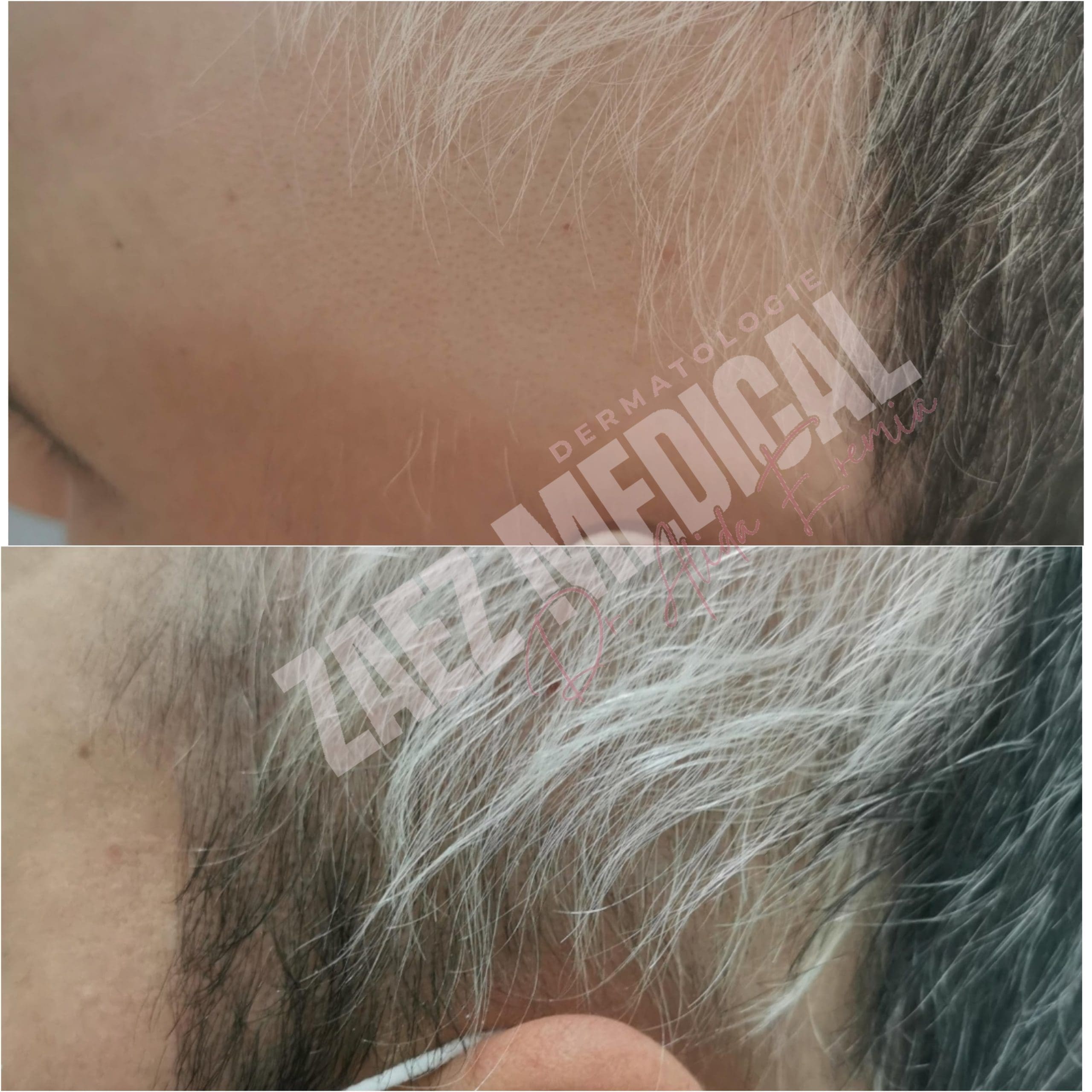 terapia vampir prp