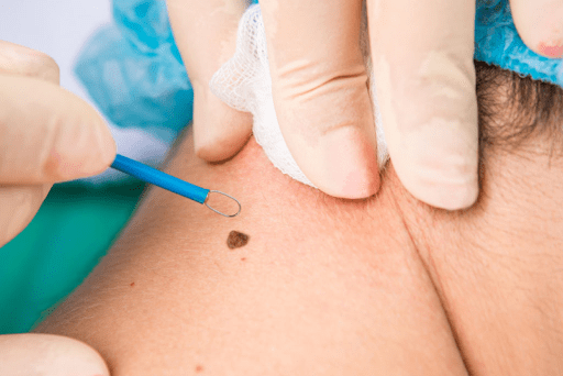 dermatologie sector 6