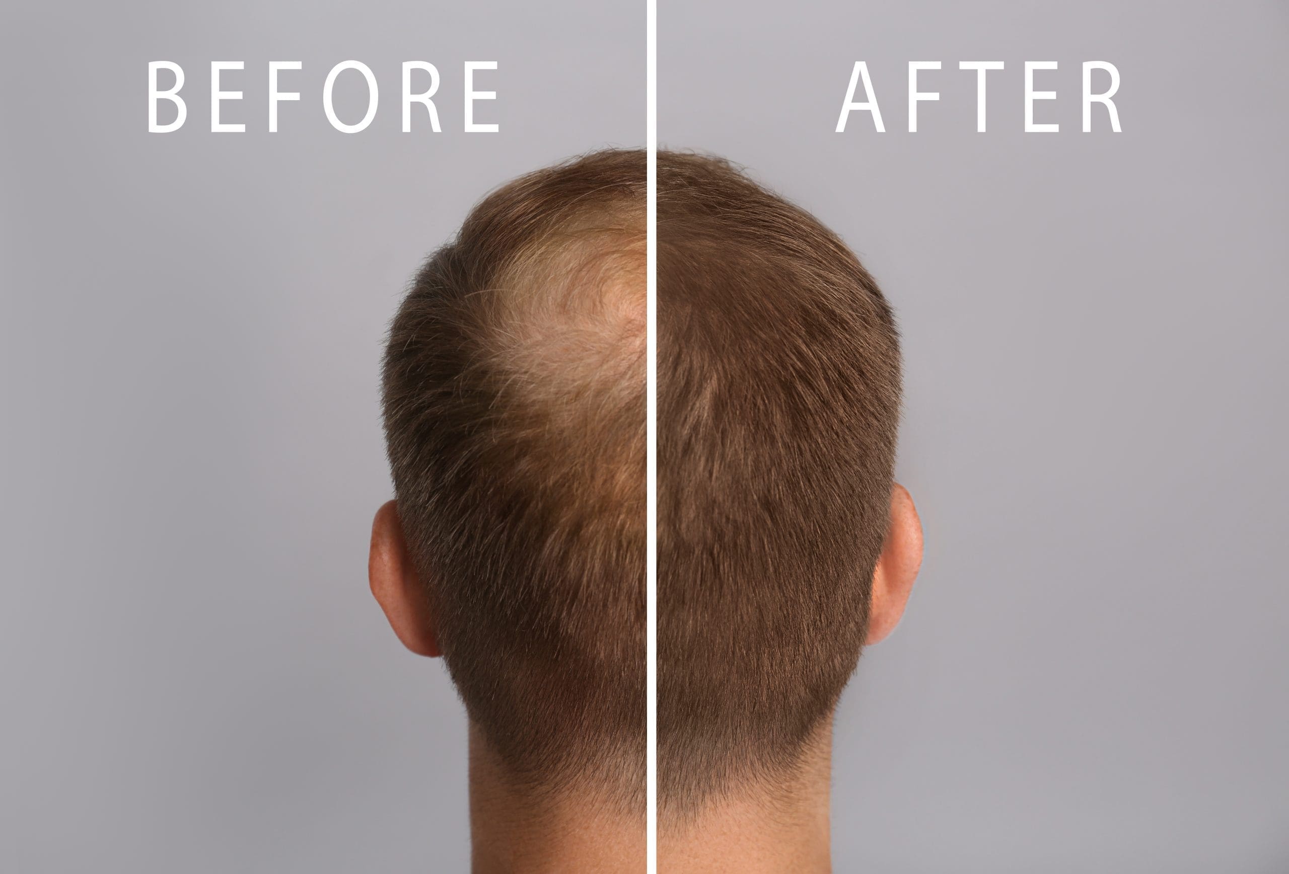 PRP scalp alopecie